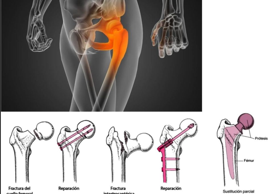 Trocanteritis Trocanteritis